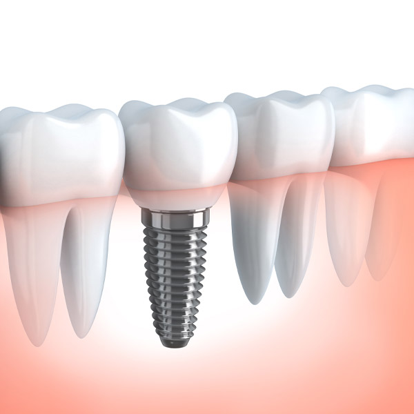 dental implants